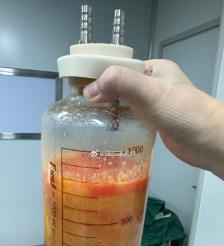 通许水动力吸脂手术要做多久？
